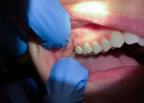 Best Emergency Tooth Extraction  in Grantley, PA